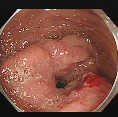 進行した大腸がん